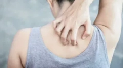 Ako odstrániť itch po uhryznutí bugs